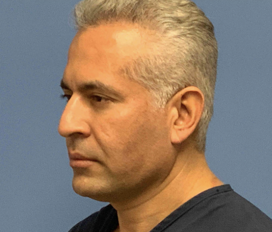 Facetite--amp--Liposuction | Before Face